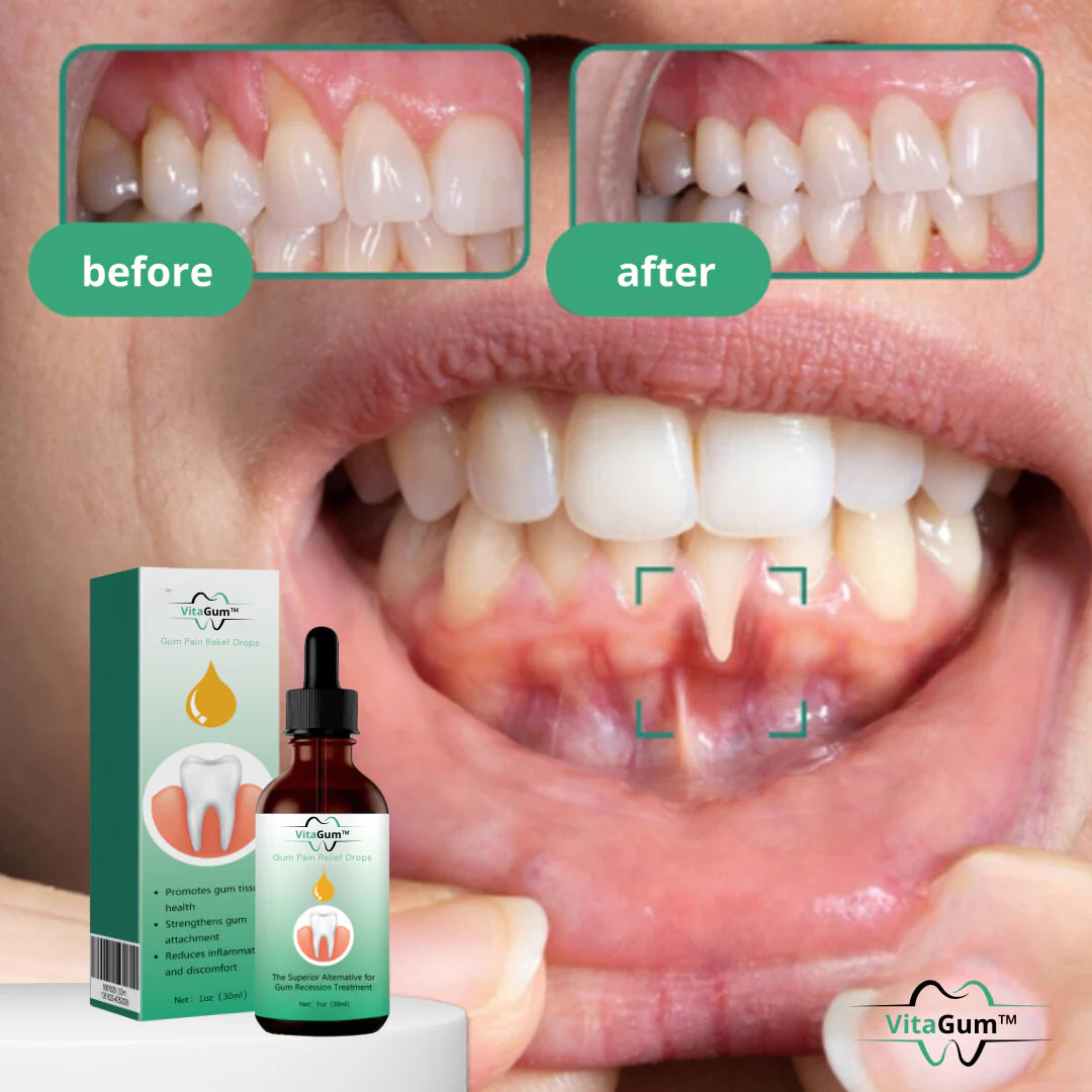 „VitaGum™ Gum Repair Drops | Tilgad, mis tervendavad, naeratused, mis kestavad!